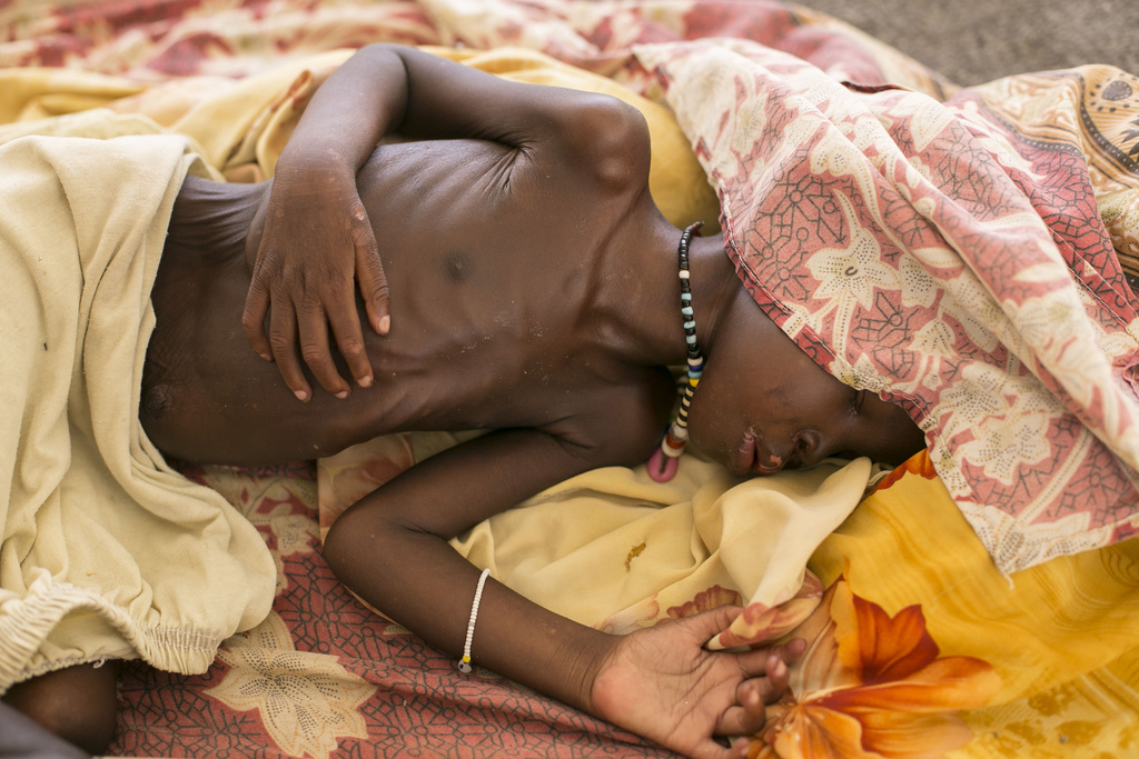 A severally malnourished child lies on the bed at MSF hospital Bentiu, South Sudan, Thursday, July 3, 2014.  Acute malnutrition and water born diseases are the main contributors to poor children?s health in Bentiu camp. Another issue is the lack of water with most only receiving 7-8 litres a day of fresh water, many turn to water from unsafe sources. (AP Photo/Matthew Abbott)