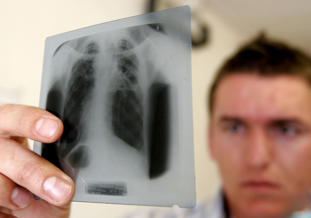 En 2011, 1,4 million de personnes sont décédées des suites de la tuberculose dans le monde.